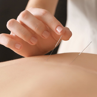 Les bienfaits de l'acupuncture